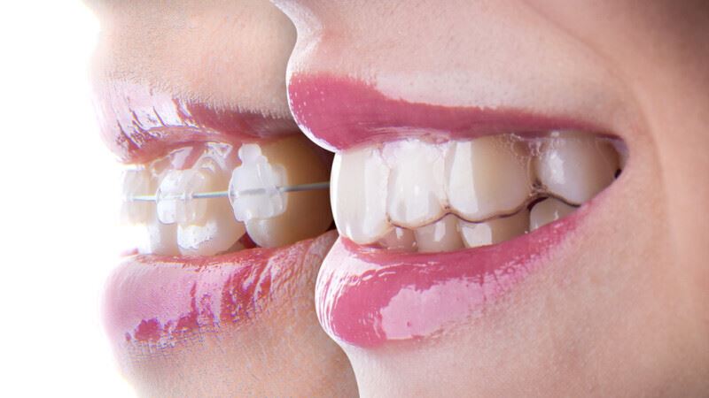 Top beneficii ale aparatului dentar Invisalign