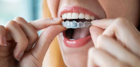 Top beneficii ale aparatului dentar Invisalign
