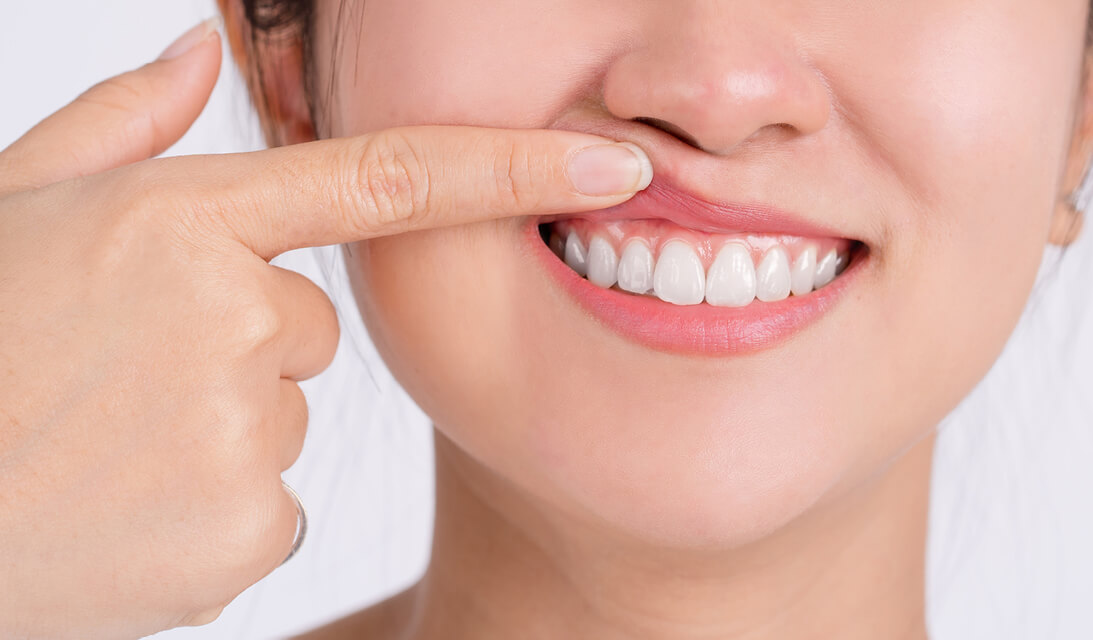 Tratament parodontoză – preț