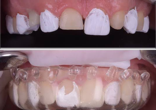 Compozit injectabil
